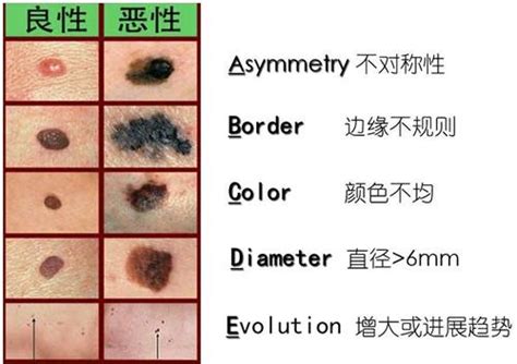 好痣壞痣怎麼分|醫師告訴你 怎麼分辨「好痣」、「壞痣」